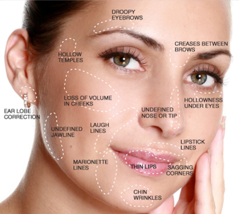 botox-filler-treatment-areas