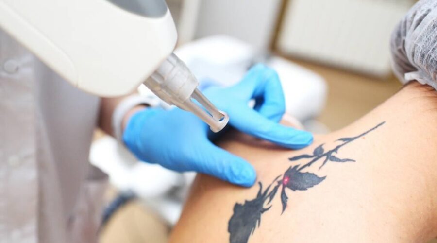 cosmetologist removes the tattoo to the patient using a neodymium laser in a modern clinic. Hardware cosmetology